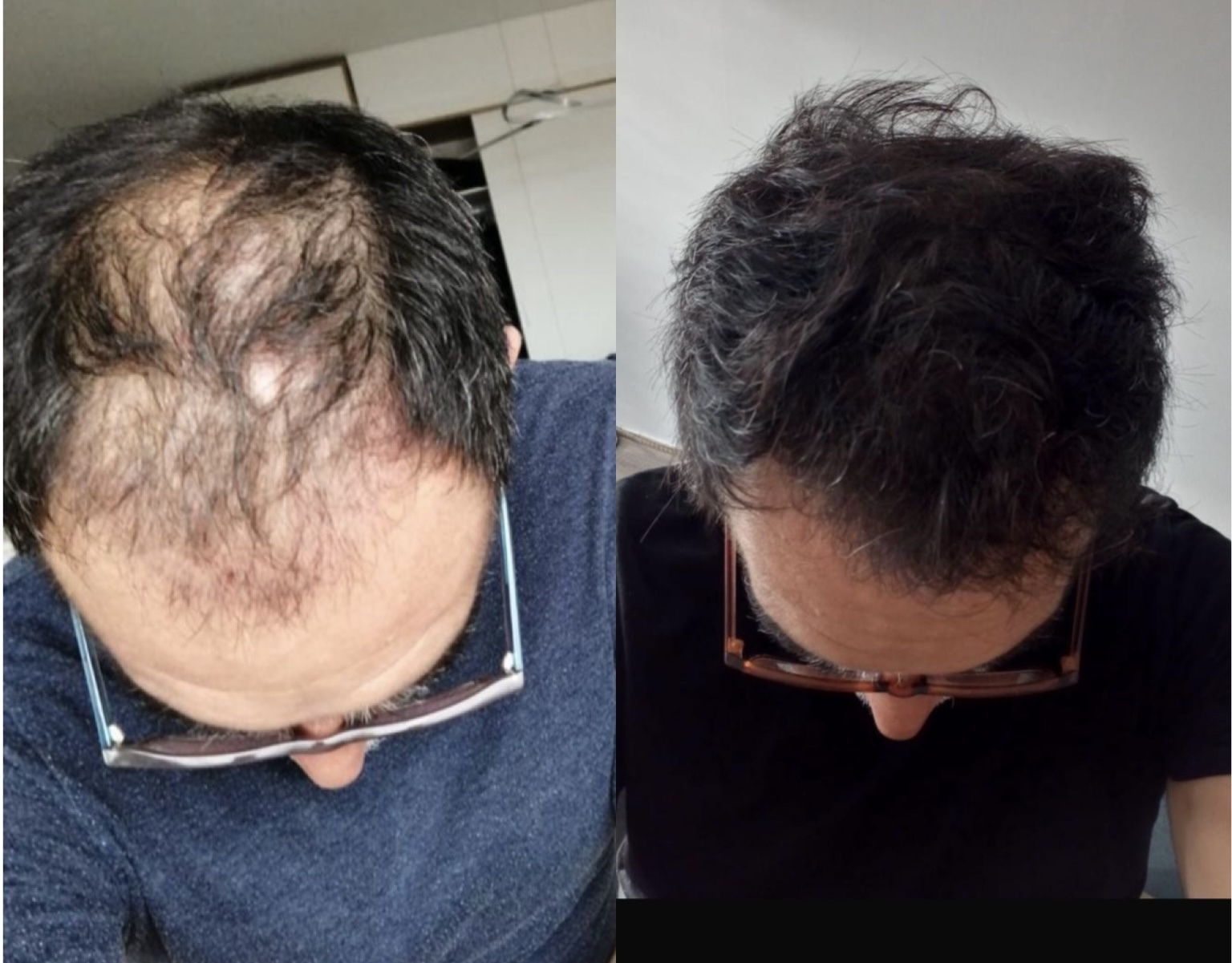 Mesoterapia capilar para la caída del cabello Mallorca