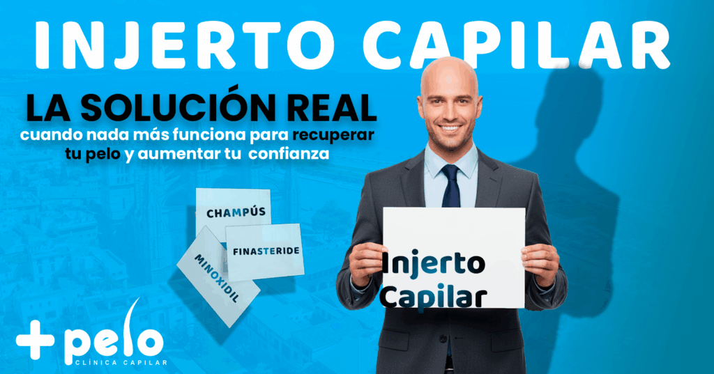 injerto capilar solución definitiva